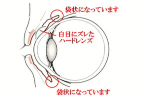 ハードコンタクトレンズずれ