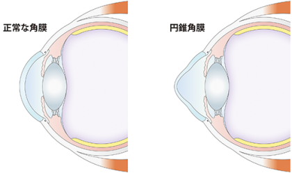 円錐角膜とは?